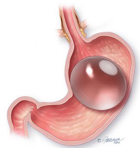 The ORBERA balloon is placed endoscopically and fills space in a patient’s stomach to reinforce proper dietary portion control.